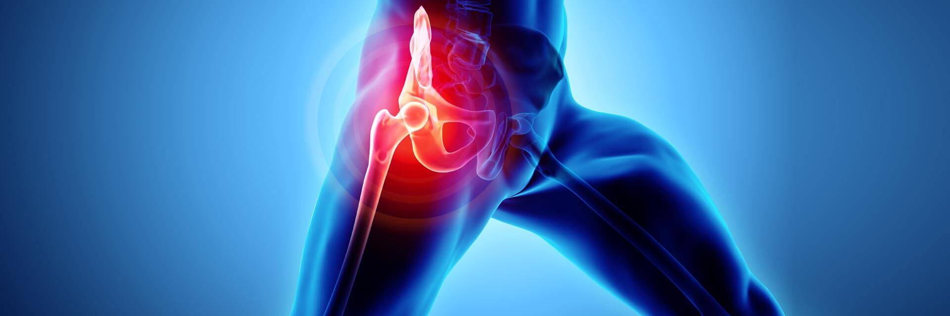 HIP ARTHROPLASTY Slide-1