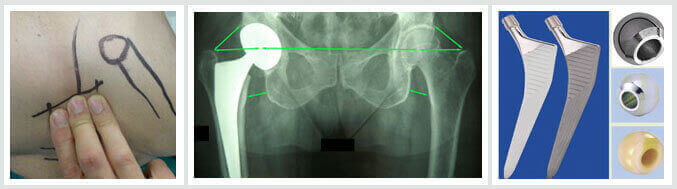 HIP ARTHROPLASTY - Ακτινογραφία